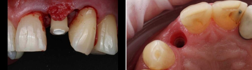 Custom healing abutment at 22 and the shaped emergence profile on removal