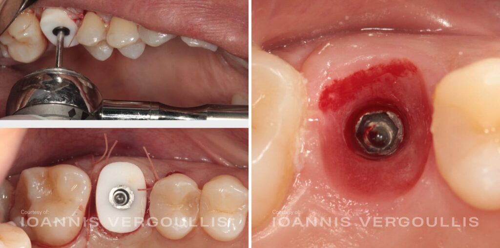 Healing abutment at placement and the emergence profile at four months, maxillary molar